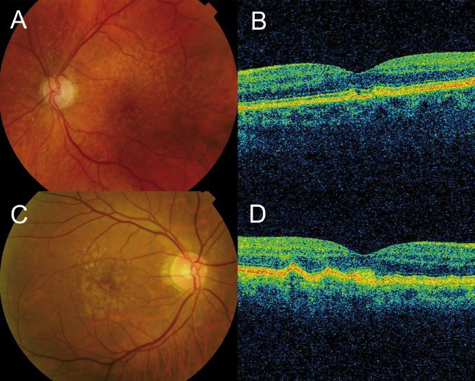 Macular Degeneration OCT scans